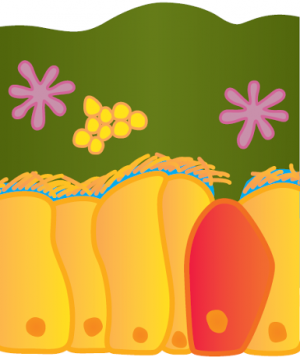 fig4_png Figur 4. Når man har cystisk fibrose virker fimrehårene ikke da vandet fra celleoverfladen er blevet suget ind. Derfor kommer mucusen ikke ud af lungen. Det giver bakterier mulighed for at slå sig ned, inde i den dejlige varme.